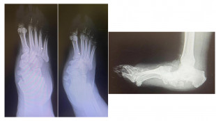 Diabete, al Gemelli soluzioni avanzate per il piede di Charcot